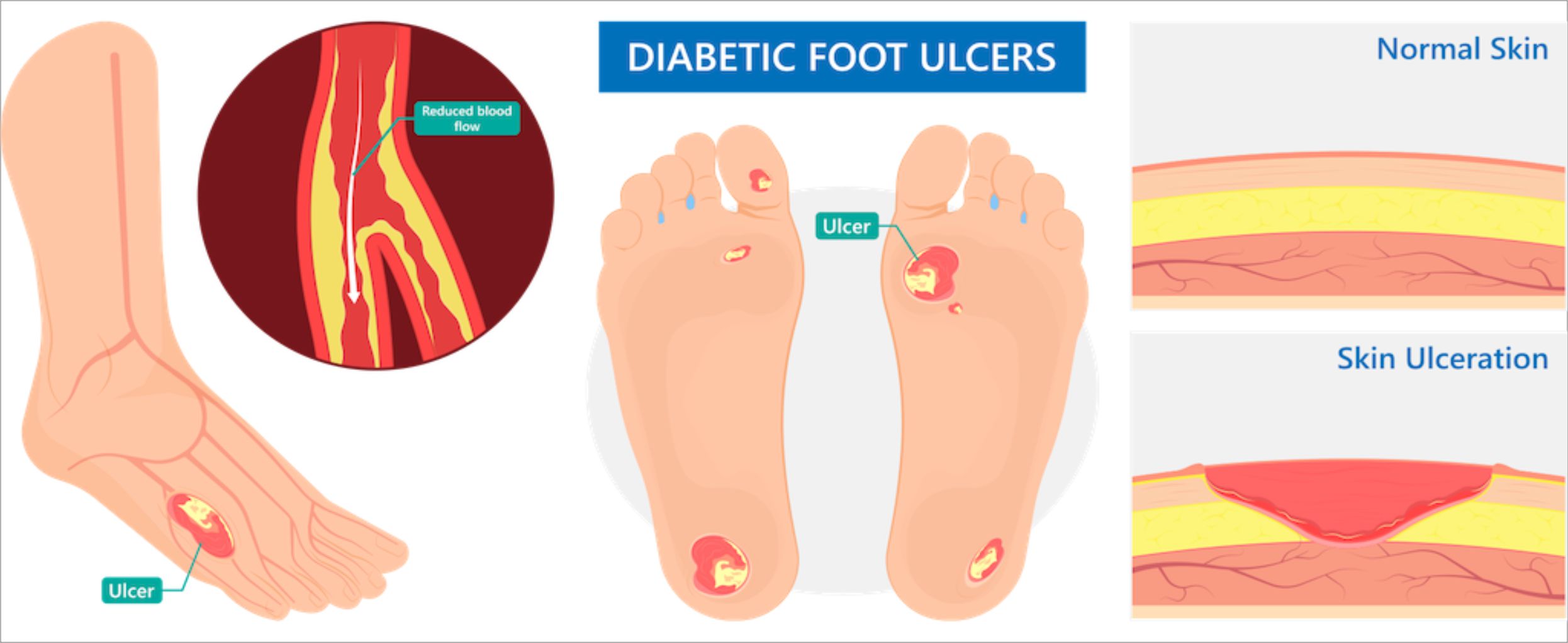 HBOT Treatment for Diabetic Foot Ulcers